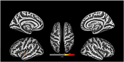 Cortical Complexity in People at Ultra-High-Risk for Psychosis Moderated by Childhood Trauma